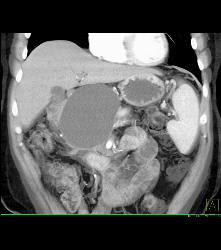 Pseudocyst With Collateral Vessels - CTisus CT Scan