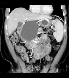 Pseudocyst With Collateral Vessels - CTisus CT Scan