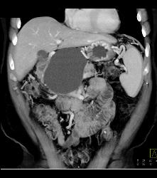 Pseudocyst With Collateral Vessels - CTisus CT Scan