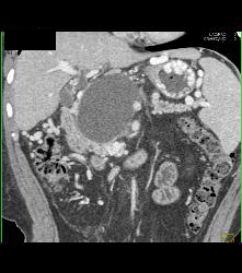 Pseudocyst With Collateral Vessels - CTisus CT Scan