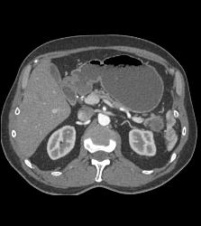 Intraductal Papillary Mucinous Neoplasm (IPMN) of Tail of Pancreas - CTisus CT Scan