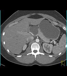 Intraductal Papillary Mucinous Neoplasm (IPMN) - CTisus CT Scan