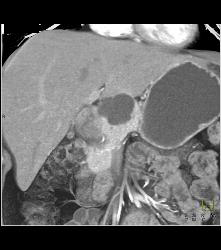 Intraductal Papillary Mucinous Neoplasm (IPMN) - CTisus CT Scan