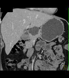 Intraductal Papillary Mucinous Neoplasm (IPMN) - CTisus CT Scan