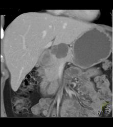 Intraductal Papillary Mucinous Neoplasm (IPMN) - CTisus CT Scan