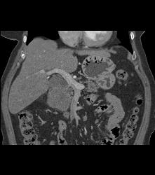 Peripancreatic Nodal Mass Near Head of the Pancreas - CTisus CT Scan