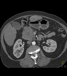 Peripancreatic Nodal Mass Near Head of the Pancreas - CTisus CT Scan