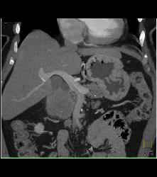 Peripancreatic Nodal Mass Near Head of the Pancreas - CTisus CT Scan