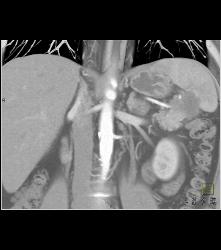 Carcinoma of the Pancreatic Tail - CTisus CT Scan