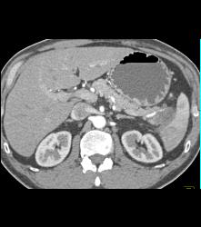 Carcinoma of the Pancreatic Tail - CTisus CT Scan