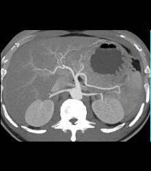 Carcinoma of the Pancreatic Tail - CTisus CT Scan