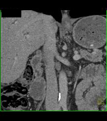 Ampullary Mass With Dilated Common Bile Duct and Stent in the CBD - CTisus CT Scan