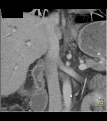 Ampullary Mass With Dilated Common Bile Duct and Stent in the CBD - CTisus CT Scan