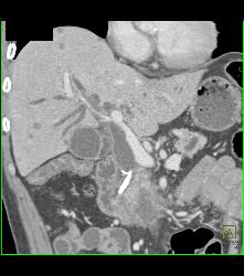 Ampullary Mass With Dilated Common Bile Duct and Stent in the CBD - CTisus CT Scan