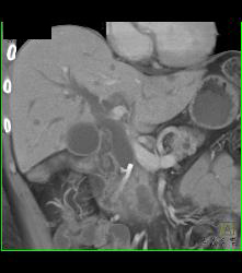 Ampullary Mass With Dilated Common Bile Duct and Stent in the CBD - CTisus CT Scan