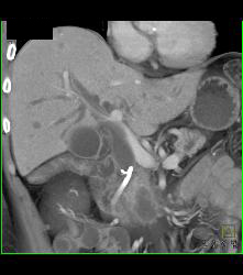 Ampullary Mass With Dilated Common Bile Duct and Stent in the CBD - CTisus CT Scan