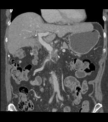 Pancreatic Cancer Encases the PV/SMV Confluence - CTisus CT Scan