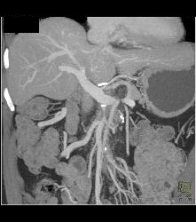 Pancreatic Cancer Encases the PV/SMV Confluence - CTisus CT Scan