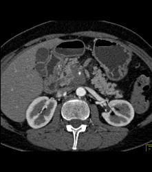 Pancreatic Cancer Encases the PV/SMV Confluence - CTisus CT Scan