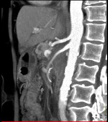 Pancreatic Cancer Encases the PV/SMV Confluence - CTisus CT Scan