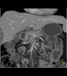 Pancreatic Cancer Encases the PV/SMV Confluence - CTisus CT Scan