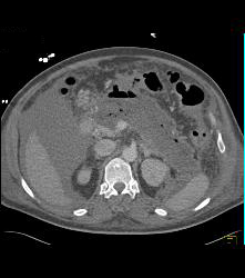 Pancreatic Necrosis - CTisus CT Scan