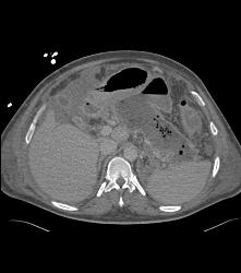 Pancreatic Necrosis - CTisus CT Scan