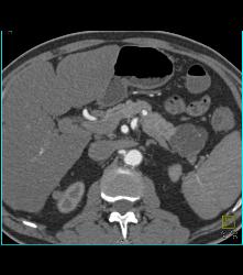 Cystadenoma - CTisus CT Scan