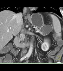 Pseudocyst Tail of Pancreas - CTisus CT Scan