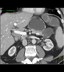 Intraductal Papillary Mucinous Neoplasm (IPMN) - CTisus CT Scan