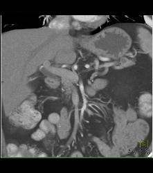 Intraductal Papillary Mucinous Neoplasm (IPMN) - CTisus CT Scan