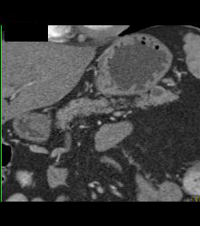 Intraductal Papillary Mucinous Neoplasm (IPMN) - CTisus CT Scan