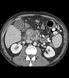 Pancreatic Cancer Encases the Portal Vein and Superior Mesenteric Vein (SMV) Junction and Occludes the Splenic Vein. Extensive Collaterals Are Seen - CTisus CT Scan