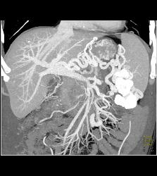 Pancreatic Cancer Encases the Portal Vein and Superior Mesenteric Vein (SMV) Junction and Occludes the Splenic Vein. Extensive Collaterals Are Seen - CTisus CT Scan