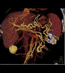 Pancreatic Cancer Encases the Portal Vein and Superior Mesenteric Vein (SMV) Junction and Occludes the Splenic Vein. Extensive Collaterals Are Seen - CTisus CT Scan