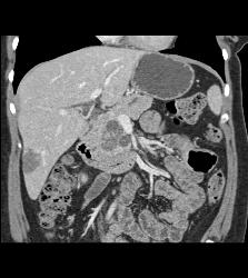 Intraductal Papillary Mucinous Neoplasm (IPMN) With Incidental Hemangioma of the Liver - CTisus CT Scan