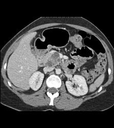 Intraductal Papillary Mucinous Neoplasm (IPMN) With Incidental Hemangioma of the Liver - CTisus CT Scan