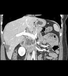 Intraductal Papillary Mucinous Neoplasm (IPMN) With Incidental Hemangioma of the Liver - CTisus CT Scan