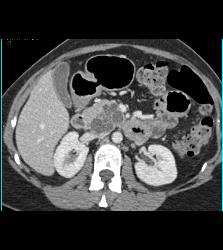 Intraductal Papillary Mucinous Neoplasm (IPMN) With Incidental Hemangioma of the Liver - CTisus CT Scan