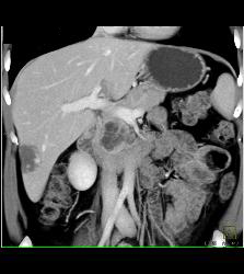 Intraductal Papillary Mucinous Neoplasm (IPMN) With Incidental Hemangioma of the Liver - CTisus CT Scan