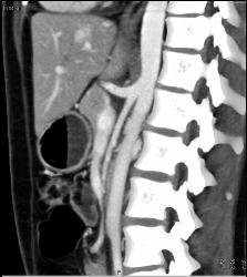 Superior Mesenteric Artery (SMA) and Celiac Arise From A Common Trunk - CTisus CT Scan