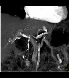 Extensive Calcification of Celiac and SMA - CTisus CT Scan