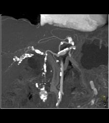 Extensive Calcification of Celiac and SMA - CTisus CT Scan