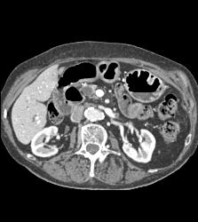 Ampullary Mass With Dilated Common Bile Duct (CBD) - CTisus CT Scan