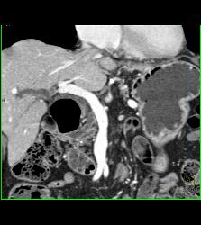 Ampullary Mass With Dilated Common Bile Duct (CBD) - CTisus CT Scan