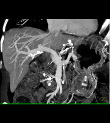 Ampullary Mass With Dilated Common Bile Duct (CBD) - CTisus CT Scan