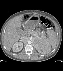 Neuroendocrine Tumor Encases and Invades the Left Kidney - CTisus CT Scan