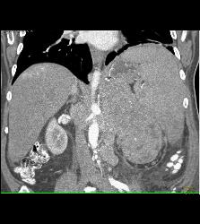 Neuroendocrine Tumor Encases and Invades the Left Kidney - CTisus CT Scan