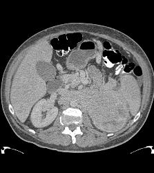 Neuroendocrine Tumor Encases and Invades the Left Kidney - CTisus CT Scan