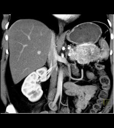 Islet Cell Tumor of the Tail of the Pancreas - CTisus CT Scan